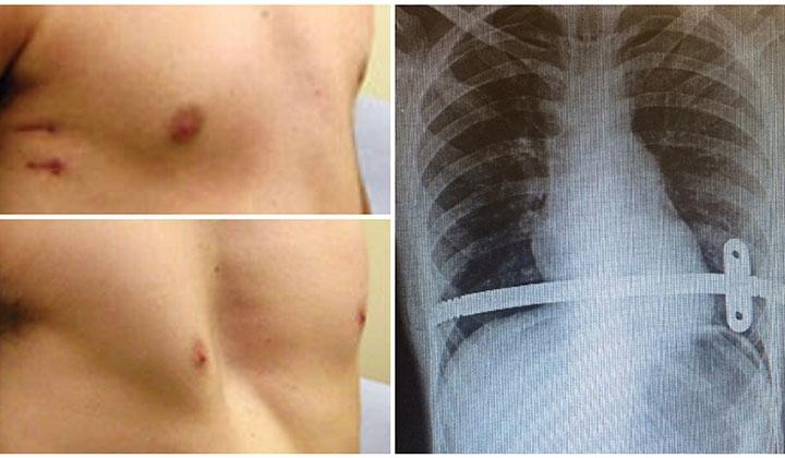 Bu hastalık çocukları yaz tatiline küstürüyor 3 Bu hastalık çocukları yaz tatiline küstürüyor