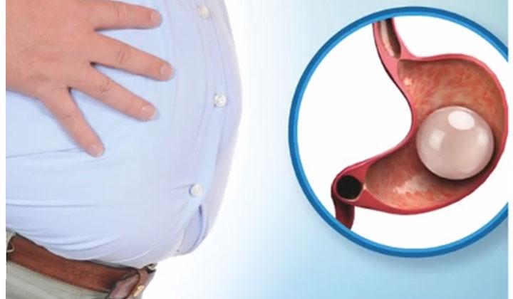 Fazla kilolar mide balonuyla uçup gidiyor 1 Fazla kilolar mide balonuyla uçup gidiyor