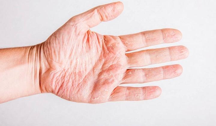 Dermatolog Dr. Füsun Bilgin Karahallı ile egzama hakkında merak edilenler 1 Dermatolog Dr. Füsun Bilgin Karahallı ile egzama hakkında merak edilenler